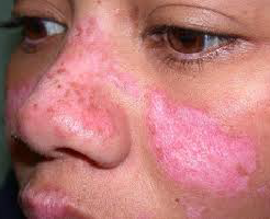 Bạn biết gì về lupus ban đỏ hệ thống ?
