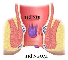 Bệnh Trĩ, Trĩ chảy máu